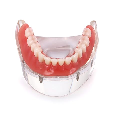 Dental Implant Teeth Demo Model Overdenture Restoration with 4 Implants Model M6003